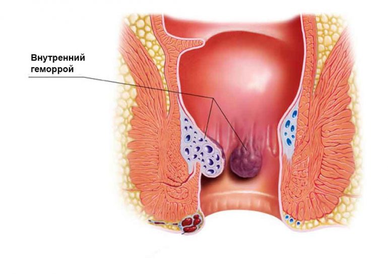 Тромбоз геморроидальных узлов: лечение