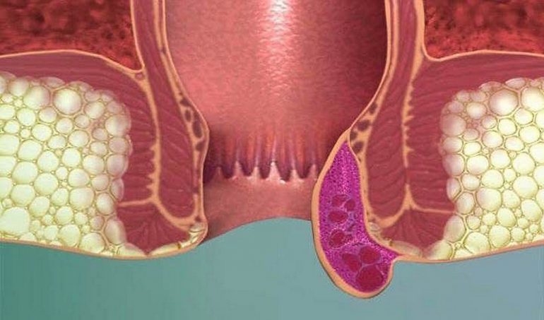 Симптомы тромбоза геморроидального узла