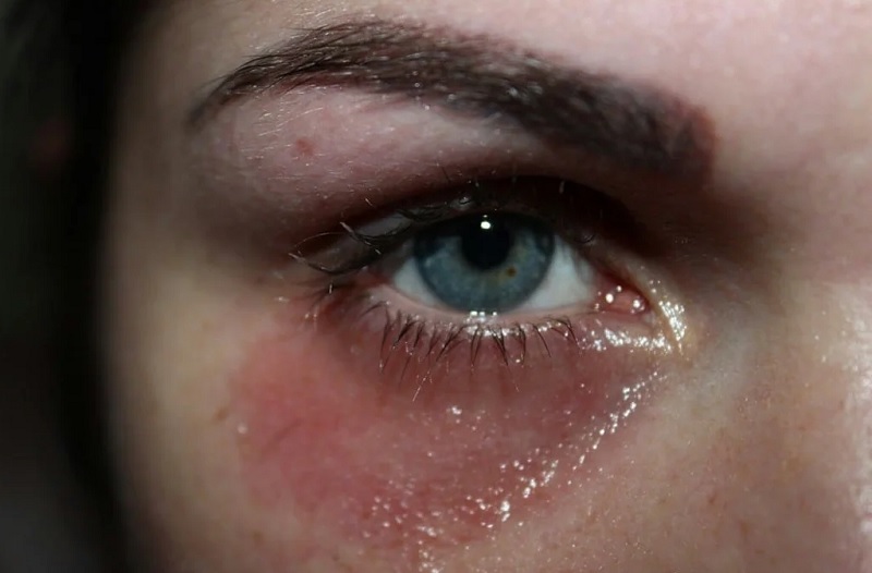 аллергия на ГМ под глазами