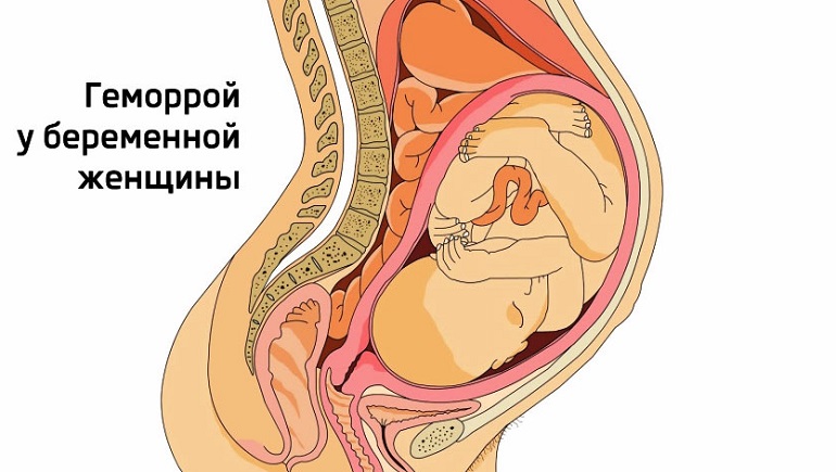 Геморрой у беременной фото